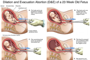 The 'Dilation and Evacuation' process of a 23 week old fetus. <br/>Life News