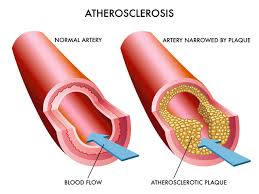 The difference between a normal artery and artery narrowed by plaque. <br/>Colliers Magazine