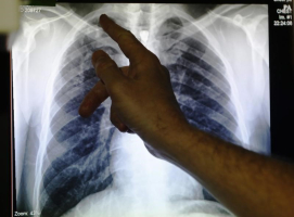 Clinical lead Doctor Al Story points to an x-ray showing a pair of lungs infected with TB (tuberculosis) during an interview with Reuters on board the mobile X-ray unit screening for TB in Ladbroke Grove in London January 27, 2014.  <br/>Reuters
