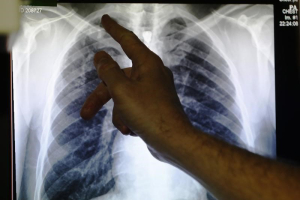 Clinical lead Doctor Al Story points to an x-ray showing a pair of lungs infected with TB (tuberculosis) during an interview with Reuters on board the mobile X-ray unit screening for TB in Ladbroke Grove in London January 27, 2014.  <br/>Reuters