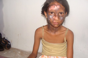 A Christian girl who was bruised and burnt during the Orissa violence in August 2008. This girl was injured with burns bruises during anti Christian violence by Hindu nationalists. It occurred when a bomb was thrown into her house by extremists. <br/>Wikimedia Commons / All India Christian Council