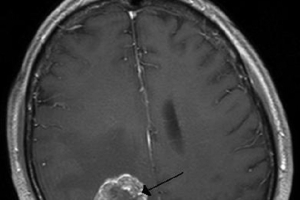 Brain metastasis in the right cerebral hemisphere from lung cancer shown on magnetic resonance imaging. <br/>Wikimedia Commons