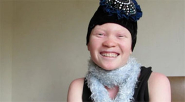 Christine Nabukenya has a condition called albinism. <br/>GodReports