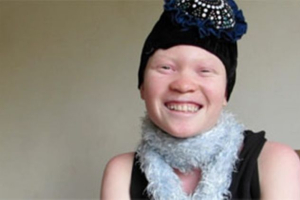 Christine Nabukenya has a condition called albinism. <br/>GodReports