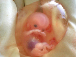 Photo showing aborted fetus <br/>Wikimedia Commons