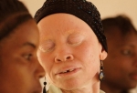 Tanzania Albinos