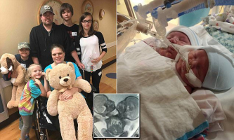 Issac and Elijah were born Sept, 5 and are conjoined in a way that they can not be safely separated. <br/>Daily Mail