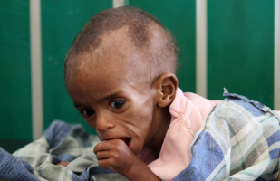 A malnourished Somali child rests inside the paediatric ward at the Banadir hospital in southern Mogadishu, August 3, 2011. <br/>Reuters/Feisal Omar