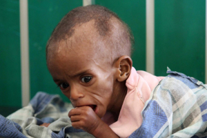 A malnourished Somali child rests inside the paediatric ward at the Banadir hospital in southern Mogadishu, August 3, 2011. <br/>Reuters/Feisal Omar