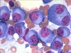 Myeloma, a rare blood cancer